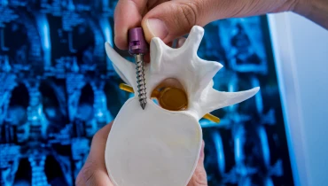 Спондилодез (фиксация позвоночника)