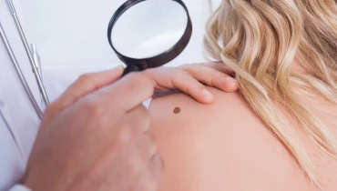 Иссечение меланомы