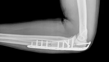 Остеосинтез предплечья