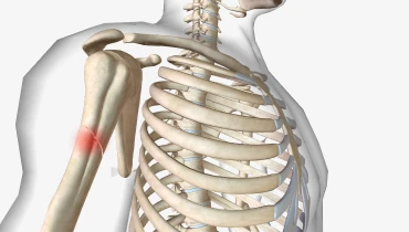 Остеосинтез плечевой кости