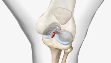 Шов мениска