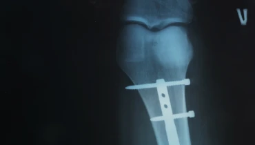 Остеосинтез штифтом