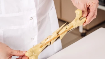 Остеосинтез костей