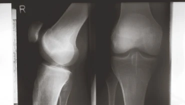 Остеосинтез надколенника