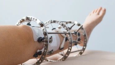 Остеосинтез аппаратом Илизарова