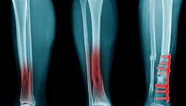 Остеосинтез голени