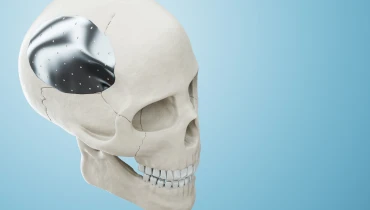 Краниопластика