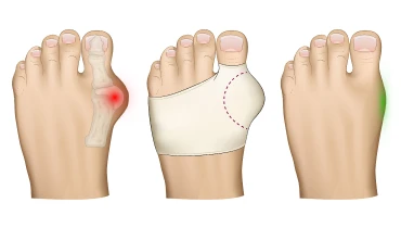 Удаление косточки (шишек) на ногах