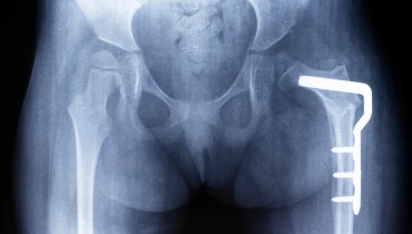 Остеосинтез бедренной кости